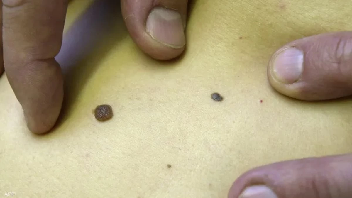 عبر "الذكاء الاصطناعي" .. أول دواء"شخصي" للسيطرة على سرطان الجلد