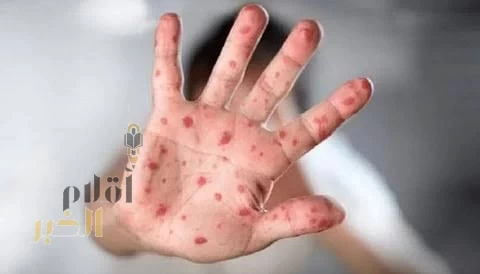 تايلاند تسجّل 40 إصابة بجدري القرود